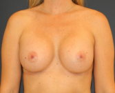 Feel Beautiful - Breast Augment Mizzou - After Photo